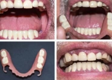 Before and After Partial Dentures