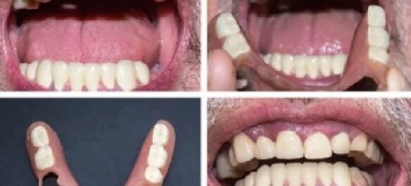 Before and After Partial Dentures