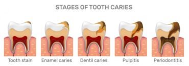 5 Dangers Of Pulling An Abscessed Tooth: Tooth Abscess Stages With ...