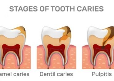 Dangers of Pulling an Abscessed Tooth