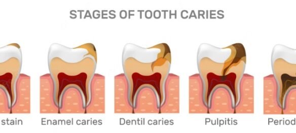 Dangers of Pulling an Abscessed Tooth