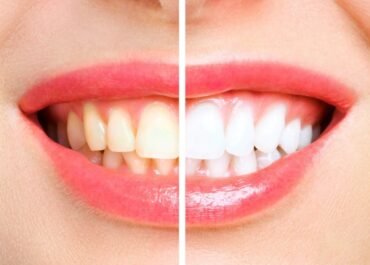 How to Whiten Teeth With Hydrogen Peroxide