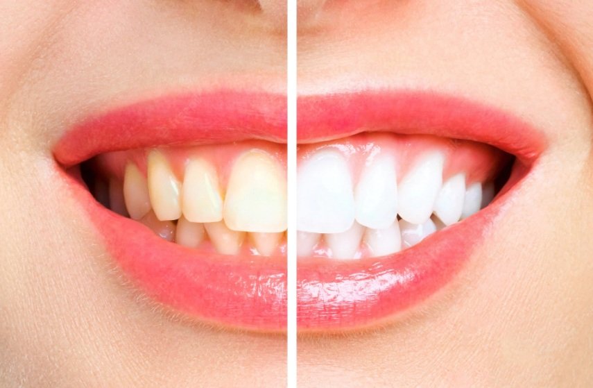 How to Whiten Teeth With Hydrogen Peroxide