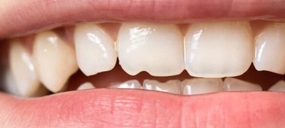 How to fix a cracked tooth naturally