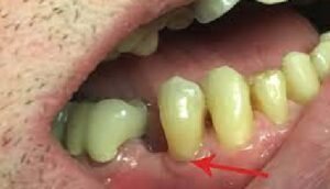 How to treat tooth decay at gum line