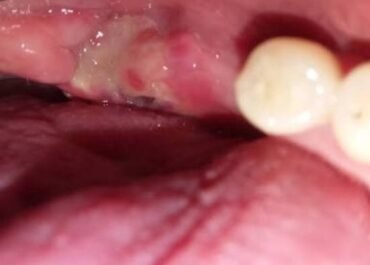 Tooth Extraction Healing White Stuff