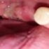 Tooth Extraction Healing White Stuff