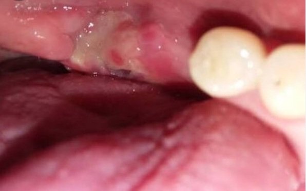 Tooth Extraction Healing White Stuff