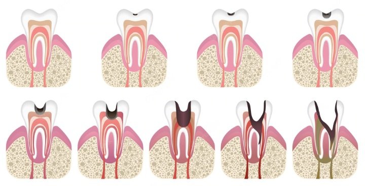 Tooth abscess stages pictures