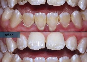 deep cleaning teeth before and after