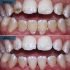 deep cleaning teeth before and after