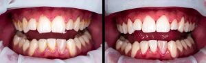deep cleaning teeth before and after pictures