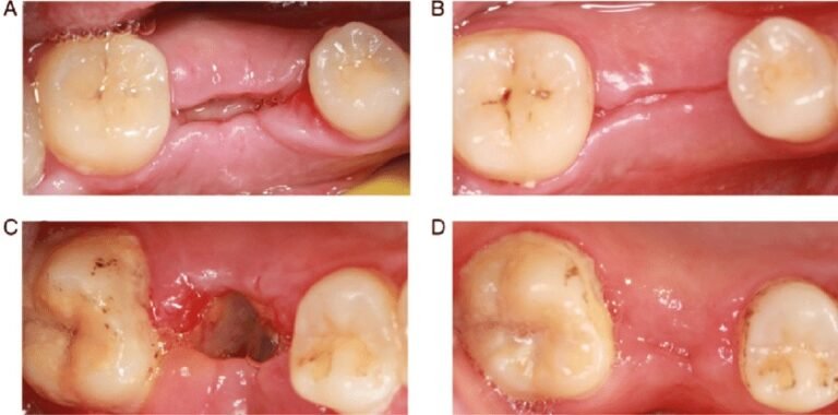 the-basics-of-tooth-extraction-dr-nechupadam-dental-clinic