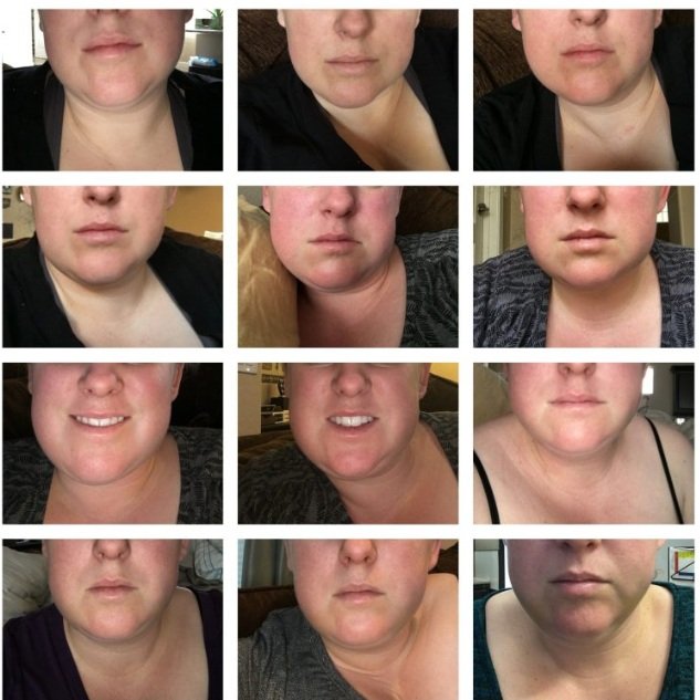 Before And After Wisdom Teeth…