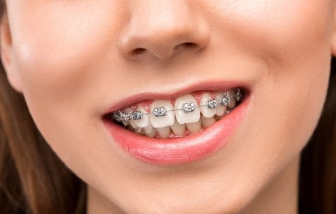 How Long do you Have to Wear Braces