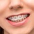 How Much Do Braces Hurt on a Scale 1 10
