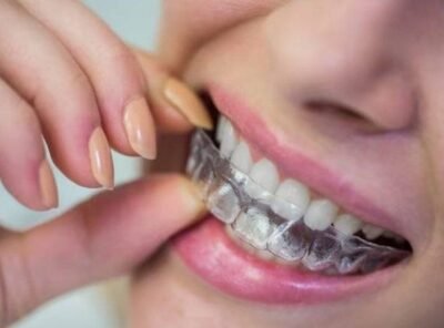 The Real Cost of Invisalign in 2026: My Honest Financial Breakdown