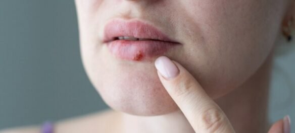 How to get rid of cold sores in 24 hours