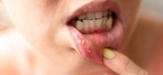 Multiple Canker Sores At Once