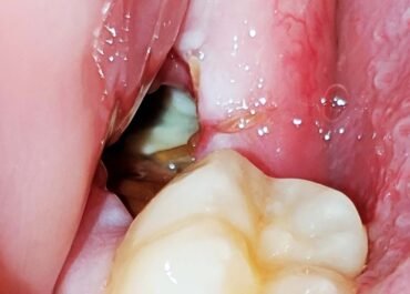 Normal Socket After Tooth Extraction