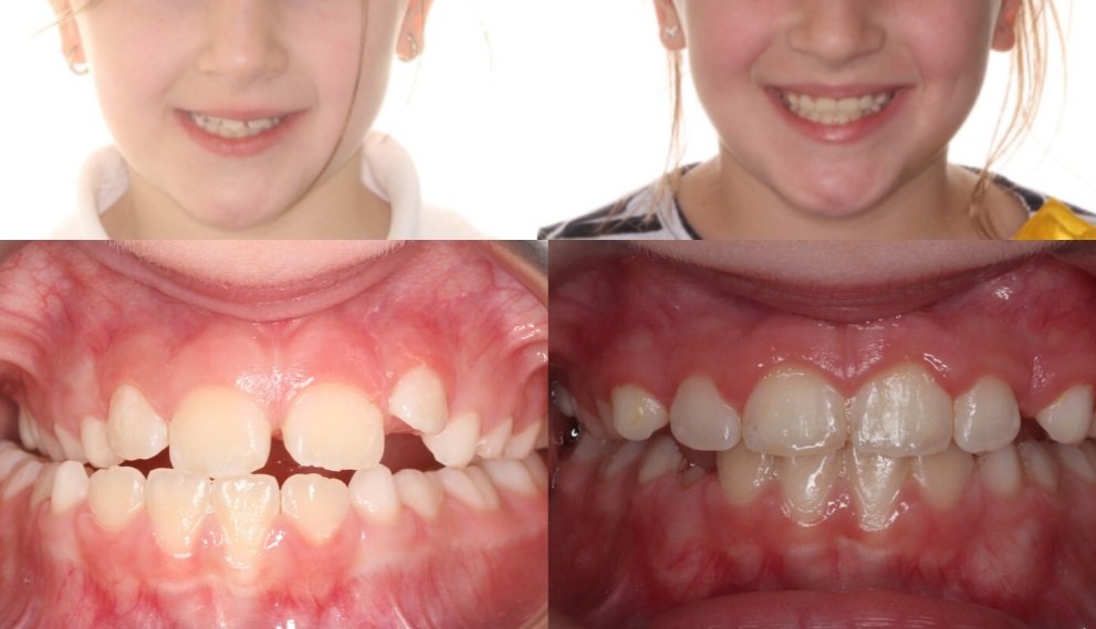 Palate Expander Before and After:…