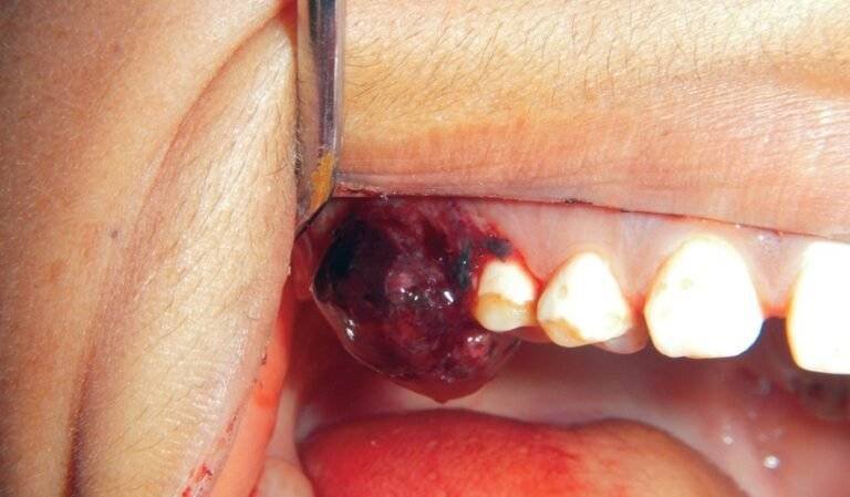 Tooth Extraction Blood Clot Fell Out: What It Really Means and What To Do Next