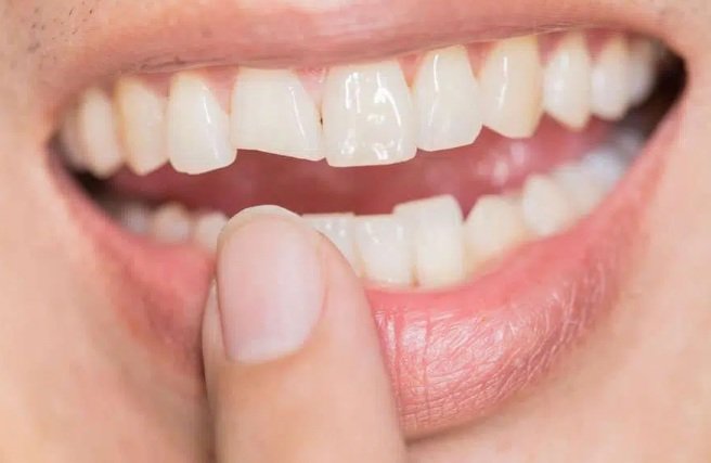 Home Remedy for Broken Tooth with Exposed Nerve