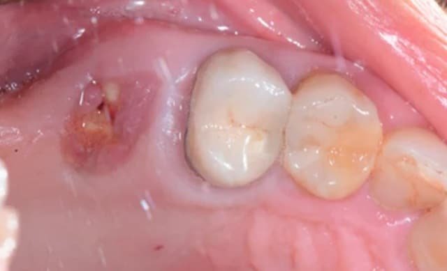 Pictures of Granulation Tissue After Tooth Extraction