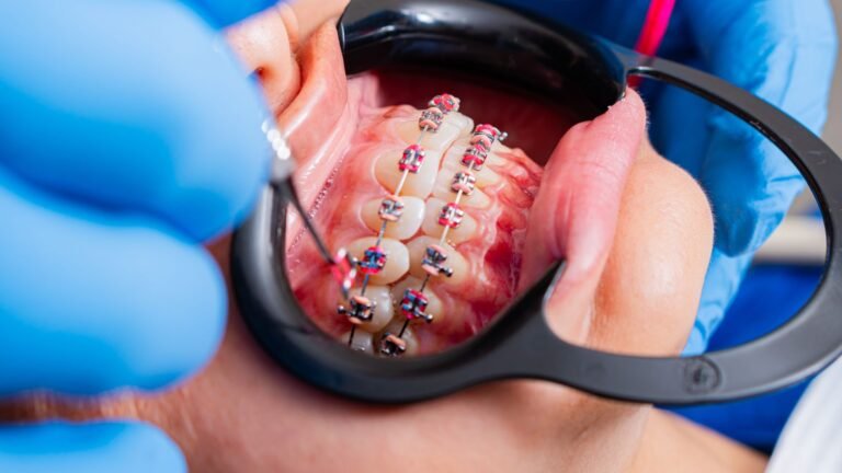Best Water Flosser For Braces