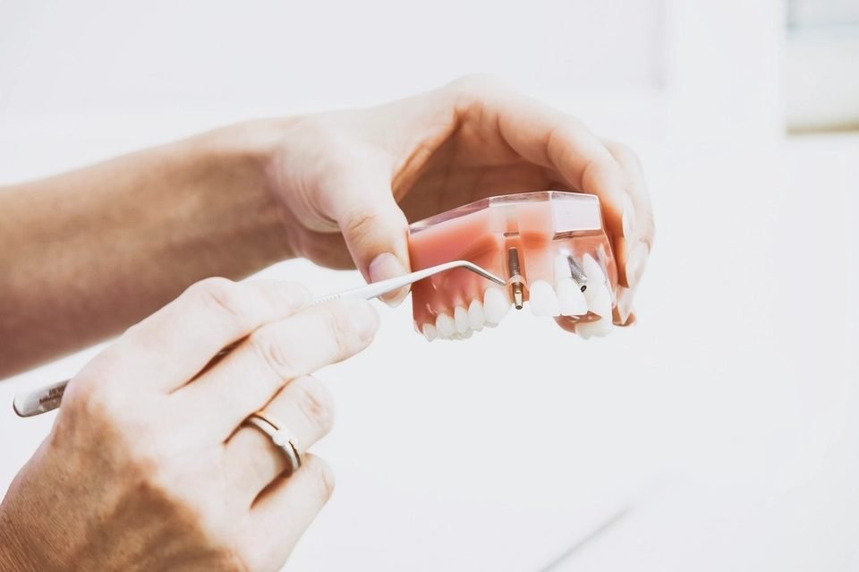 Dentist holding a dental model to explain cosmetic bonding