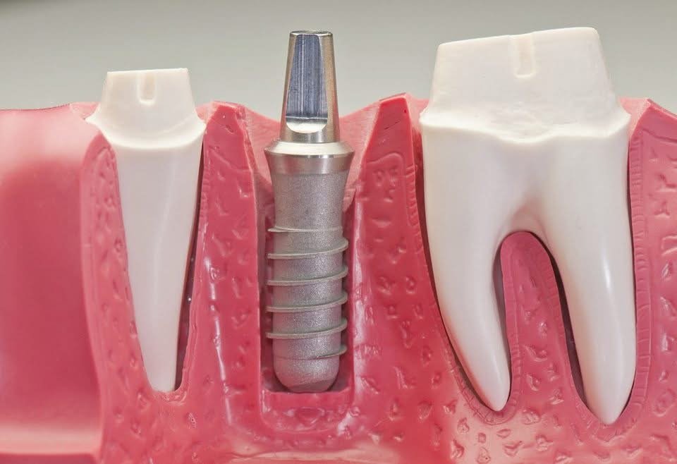 Model of a dental implant replacing a missing tooth between natural teeth