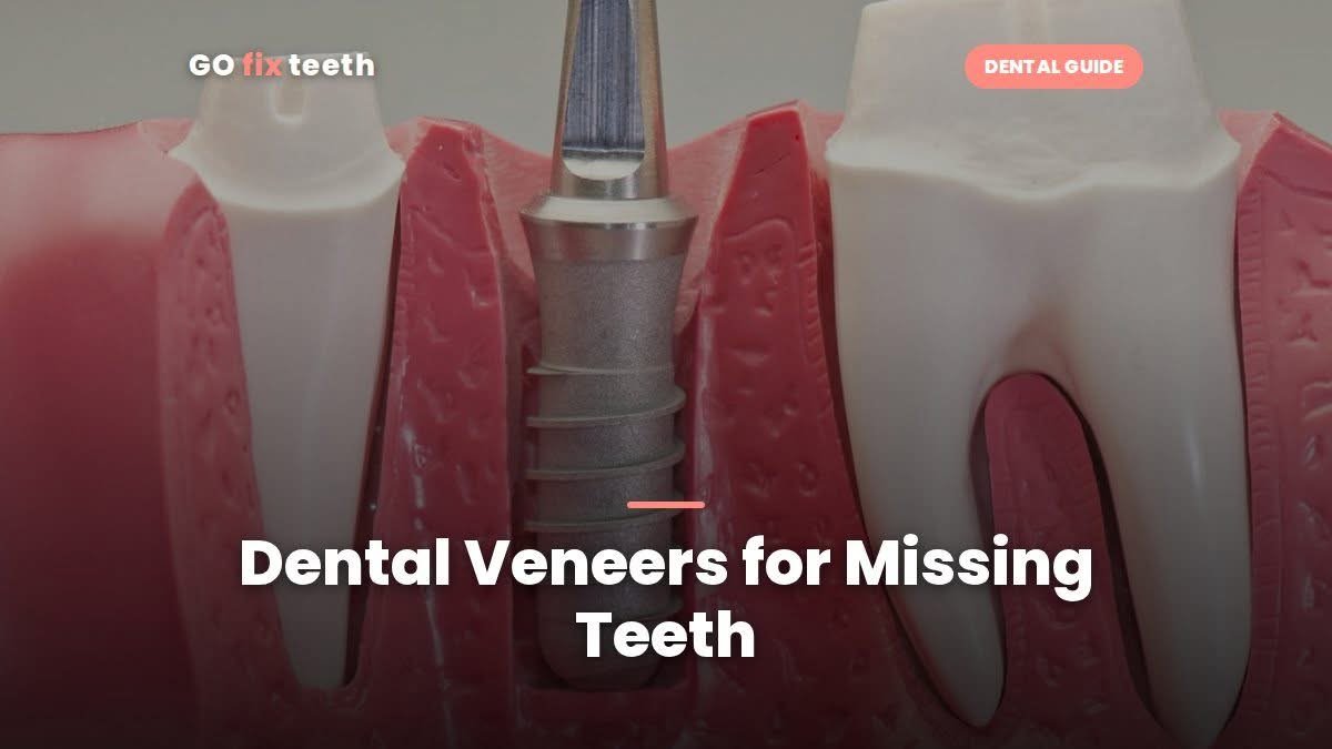 Dental Veneers for Missing Teeth: What Works Instead