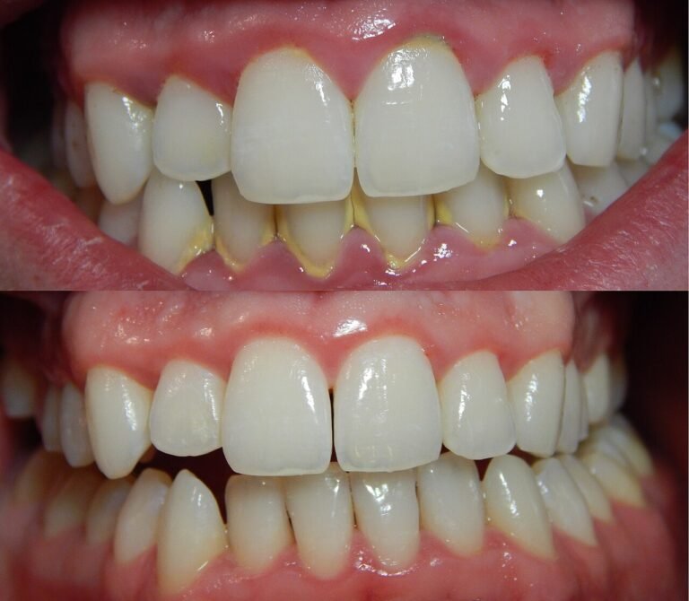 Can Gingivitis Be Reversed? How Long It Takes and What Helps