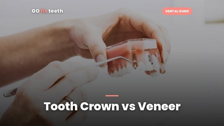 Tooth Crown vs Veneer: Differences, Cost and Lifespan