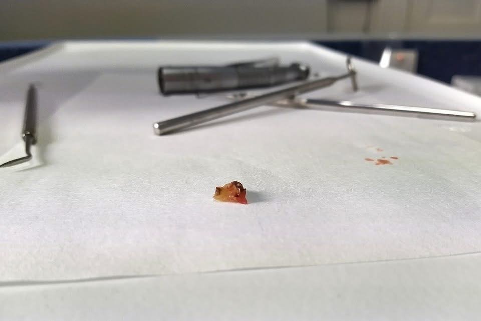 Extracted tooth and dental instruments on a tray after an extraction